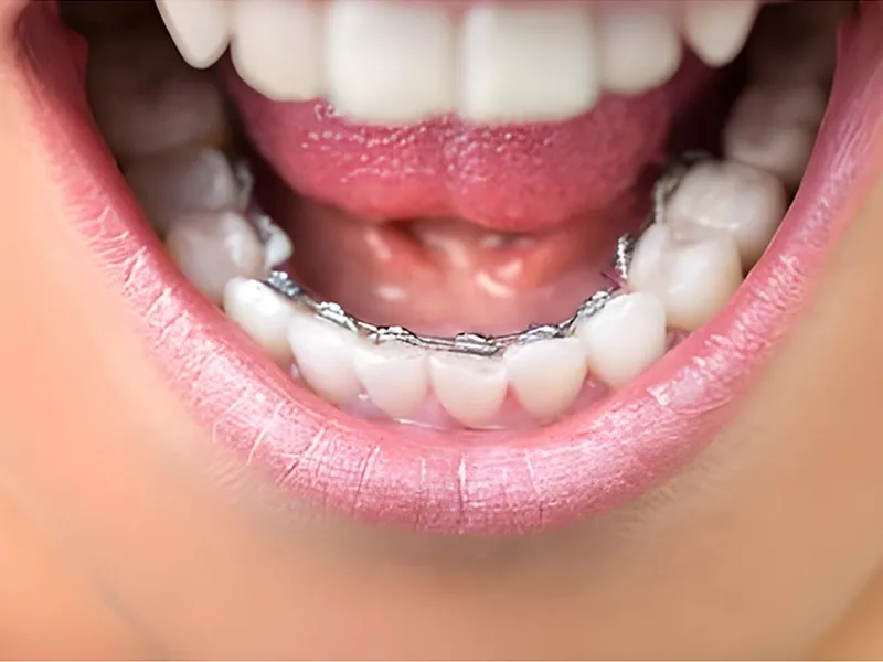 Lingual Ortodonti Nedir? Lingual Ortodonti Nedir?