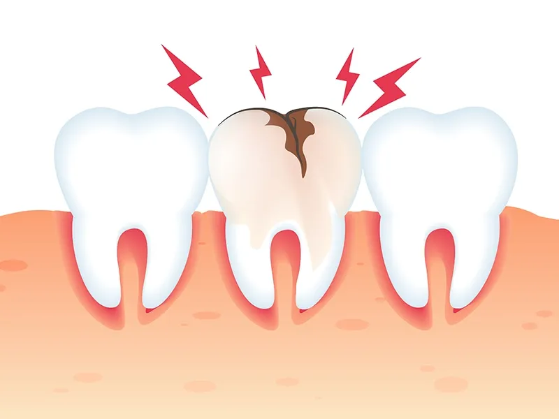 Inley ve Onley Diş Restorasyonları Inley ve Onley Diş Restorasyonları