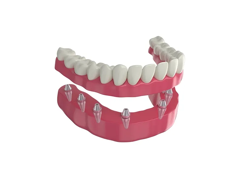 All-On-Four İmplant Tedavisi All-On-Four İmplant Tedavisi