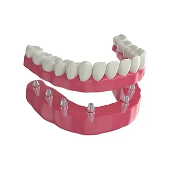 All-On-Four İmplant Tedavisi