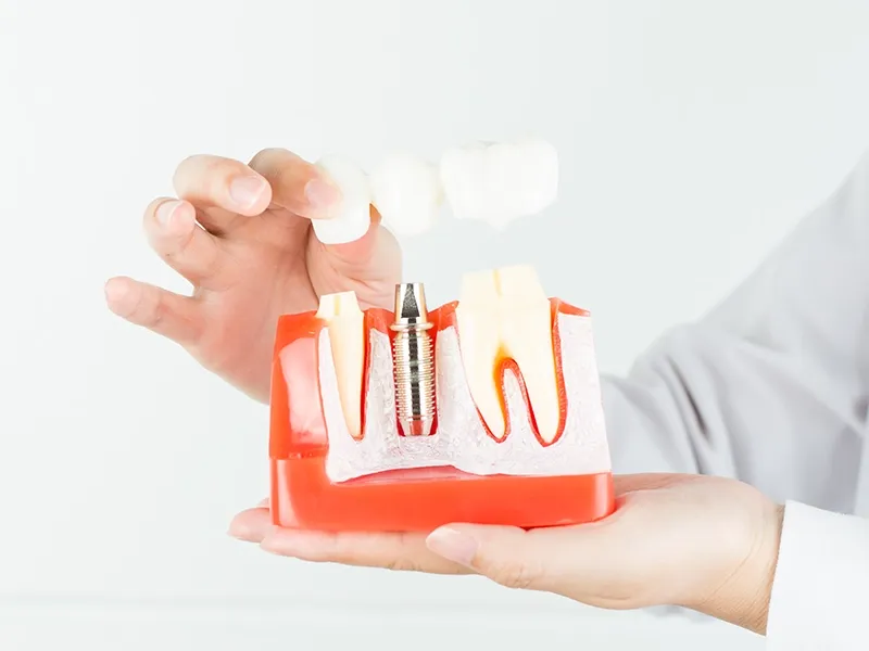 Diş İmplantı Süreci Diş İmplantı Süreci