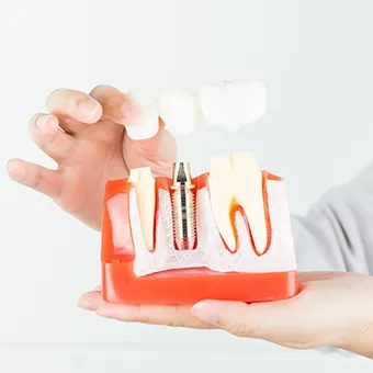 Diş İmplantı Süreci