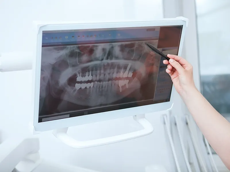 İmplant Uygulamasında Kullanılan Gelişmiş Teknolojiler